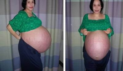 NO.2一次生育八胞胎的单身母亲