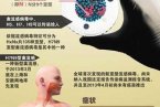 h7n9诊疗方案 卫计委公