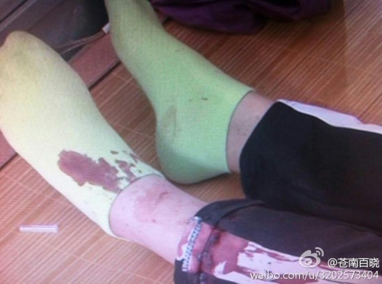 苍南龙港第九中学女生用剪刀捅伤同学
