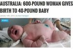 女子诞下18公斤巨婴