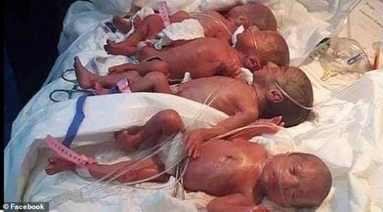 非洲马里一名25岁产妇诞下九胞胎
