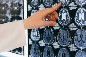 到2023年中国慢性肾病