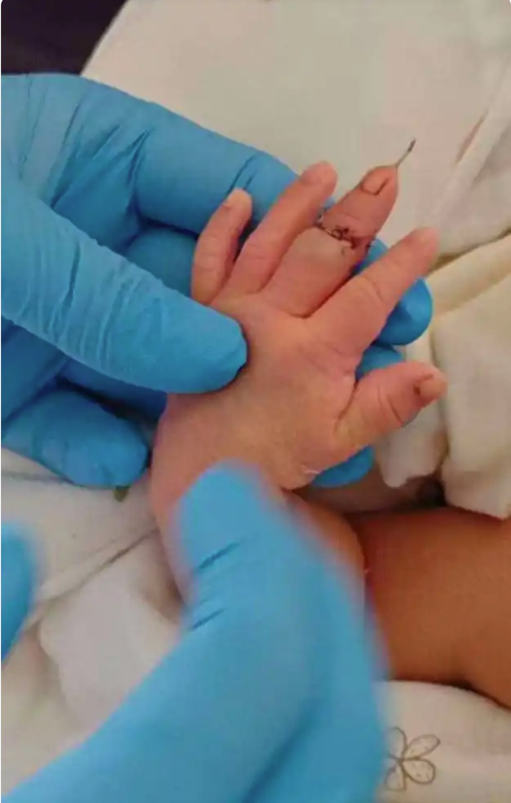 江苏盱眙县人民医院新生儿的手指被助产士切断了